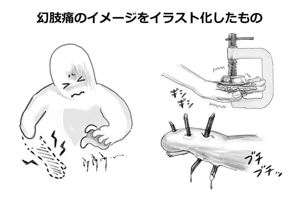 幻肢痛のイメージをイラスト化したもの
・輪郭のみの右腕が描かれており、人物がその腕に強い痛みを感じている様子を表現しています。
・手が大きな万力に挟まれている。万力が手を強く締め付け、「ギシギシ」という音が書き込まれ、圧迫感による痛みを視覚的に示している
・腕の断面が描かれ、そこに複数の釘のようなものが刺さっている。「ブチブチ」という音が付け加えられ、痛みを視覚的に示している