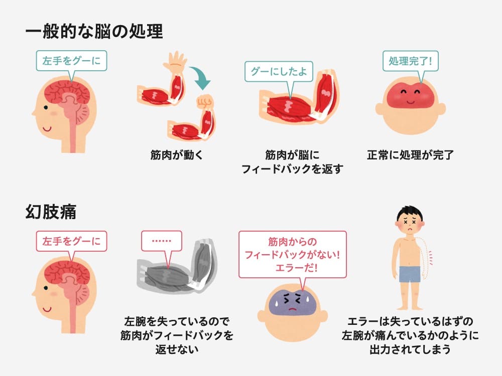 イラスト：
一般的な脳の処理

脳が「左手をグーにして」と指示を出す。
筋肉が動き、左手が握りこぶしをつくる。
筋肉が脳に「グーにした」とフィードバックを返す。
脳は正常に処理が完了し、笑顔の人物が表示される。

幻肢痛

脳が「左手をグーにして」と指示を出すが、腕がないため筋肉がフィードバックを返せない。
脳が「フィードバックがない！」とエラーを感じ、ないはずの左腕に痛みとして出力してしまう。