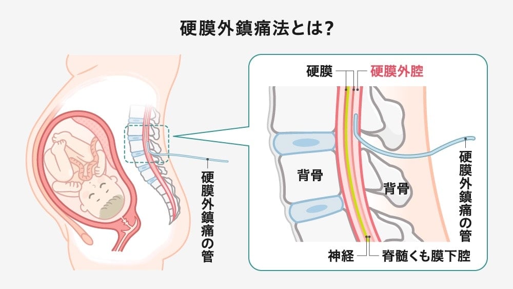 硬膜外鎮痛法の仕組み。背骨の間にある神経を包むように硬膜があり、その外側の空間を硬膜外腔と呼ぶ
