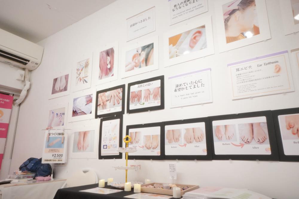 2024年11月に開催した「エピテーゼ展」の写真。壁に、エピテーゼの装着前・後の写真が掲示されている。