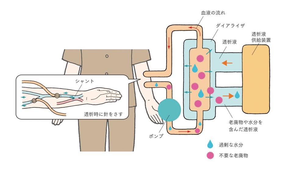血液透析の仕組みを説明するイラスト。患者の腕にあるシャントに透析用の針が刺され、血液がポンプによって体外に取り出される。血液はダイアライザ（人工腎臓）を通り、透析液供給装置から送られてくる透析液と接触することで、血液中の不要な老廃物や過剰な水分（ピンク色と青色のマーク）が透析液に移動する。浄化された血液は再び体内に戻される。
