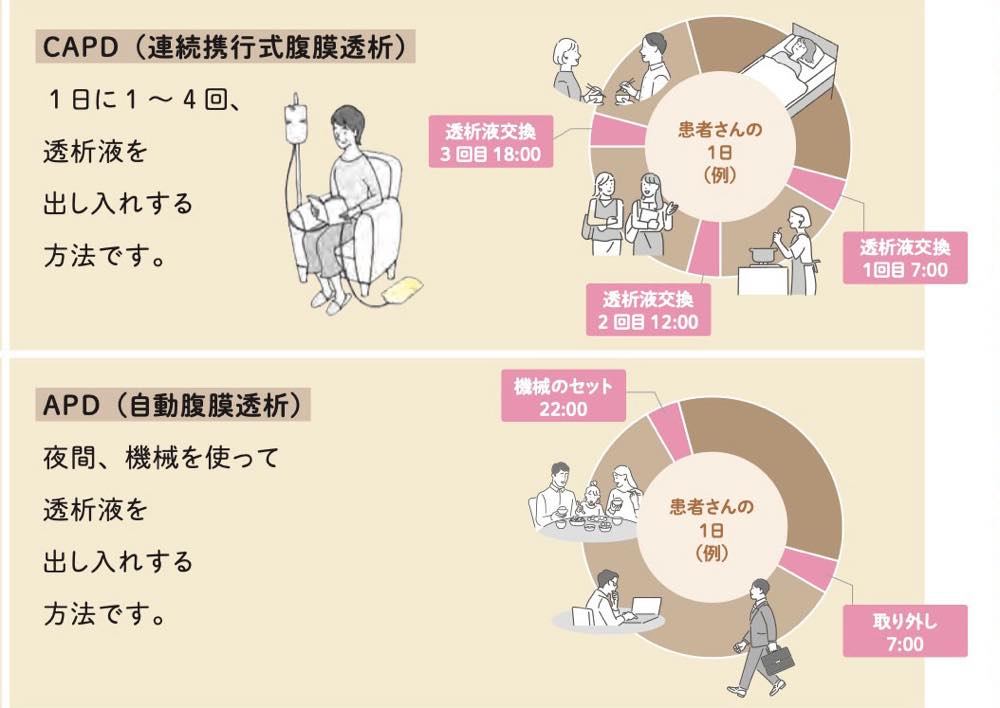 「自動腹膜透析（APD）」と「連続携行式腹膜透析（CAPD）」をしている人の生活例を示す図。「自動腹膜透析（APD）」をしている人の生活例ではは7時・12時・18時に透析液交換を行っている。「連続携行式腹膜透析（CAPD）」をしている人の生活例では、7時の起床時に透析液を出し入れする機械を取り外し、22時の就寝前に機械をセットしている。