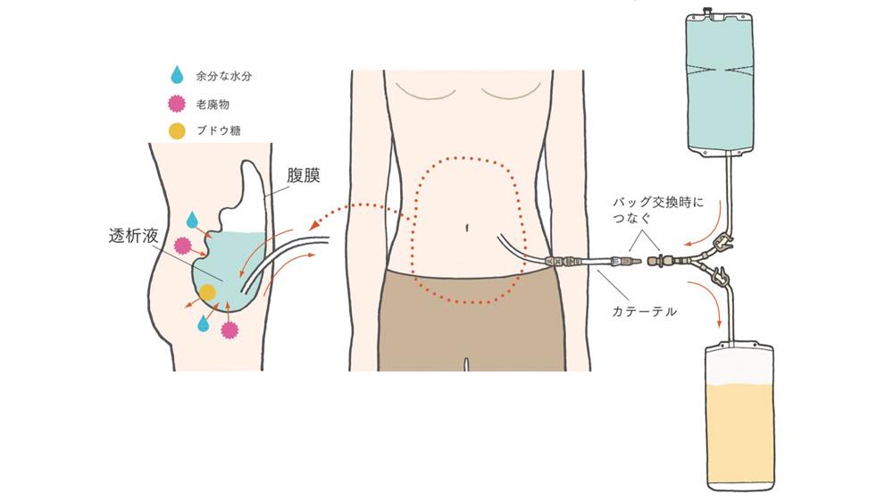 腹膜透析の仕組みを示すイラスト。患者の腹部にカテーテルが挿入されており、透析液が体内の腹膜腔に注入される。透析液は腹膜を介して血液中の老廃物や余分な水分（ピンク色と青色のマーク）を吸収し、ブドウ糖（黄色）も含まれている。一定時間経過後、使用済みの透析液は排出され、新しい透析液と交換される。透析液の出入りはバッグとカテーテルを通じて行われる。
