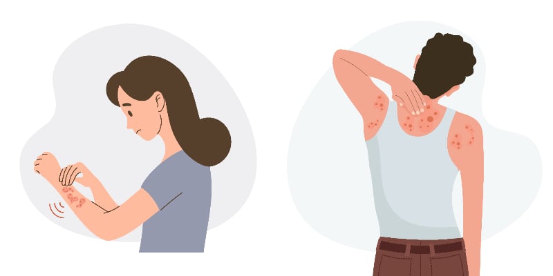 女性が自分の左腕の湿疹を右手で掻いているイラストと、男性が背中の湿疹を掻いているイラスト